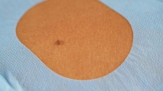 المملكة المتحدة تختبر عقار الذكاء الاصطناعي لسرطان الجلد