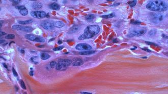 الألياف والكالسيوم مفتاح خفض خطر الإصابة بالسرطان