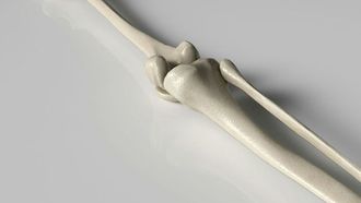 علاج واعد لإيقاف تطور هشاشة العظام