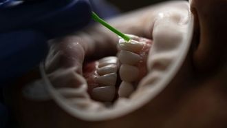 تخلخل الأسنان وأسبابه