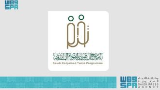 أهم التوصيات الصادرة عن مؤتمر التوائم الملتصقة