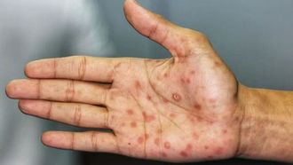 ارتفاع حالات الإصابة بمرض الزهري يتطلب اتخاذ إجراءات عاجلة