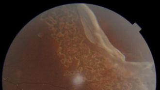 Cricket Ball Injury Saved: Boy's Vision Restored