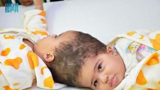 تم فصل التوأم الإريتري أسماء وسامية بنجاح