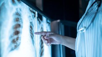 الالتهاب مرتبط بسرطان الرئة المبكر