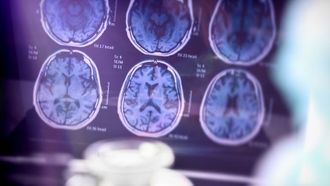 ليكانيماب يؤخر تطور مرض الزهايمر